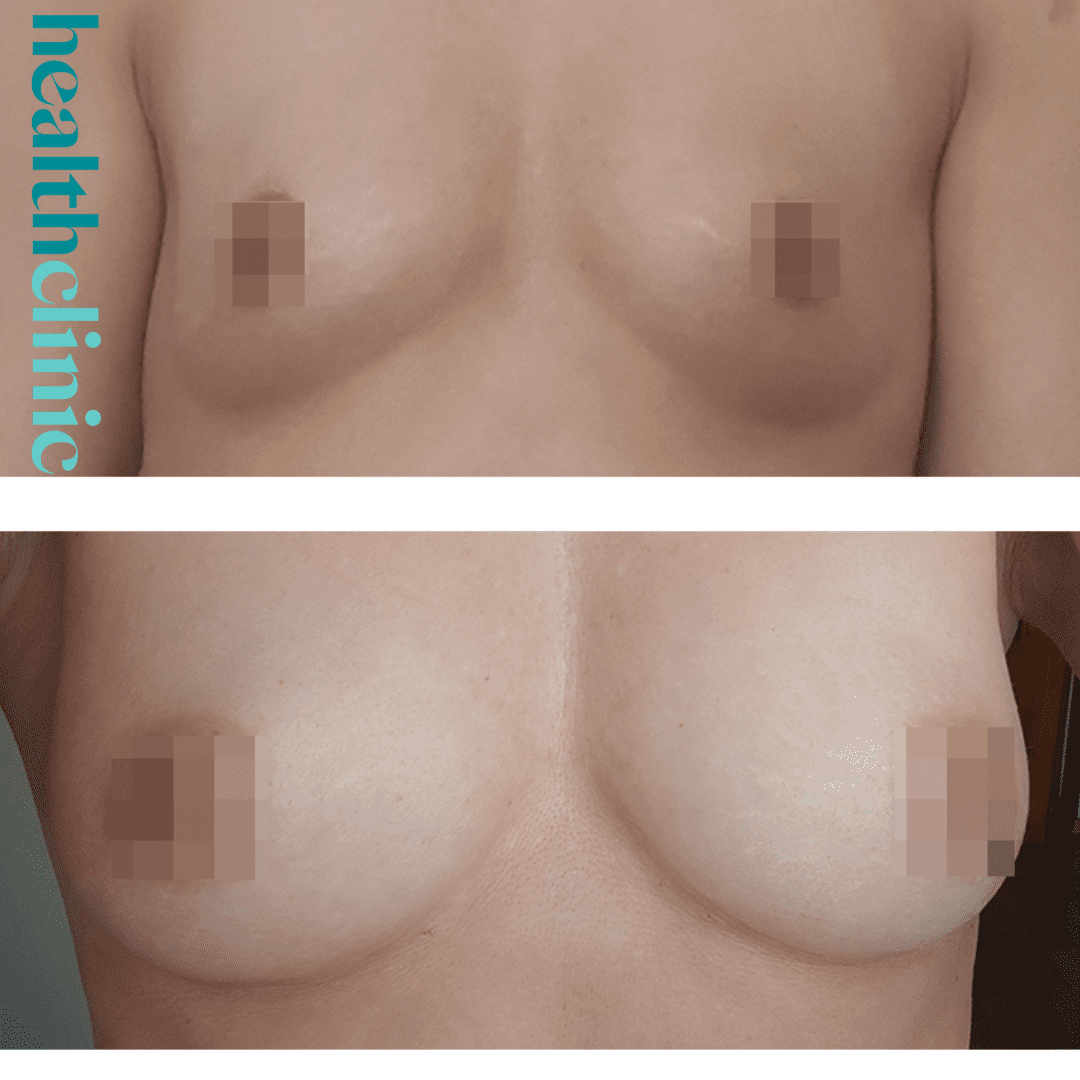 Health Clinic Kauneusklinikka 12 Lipofill