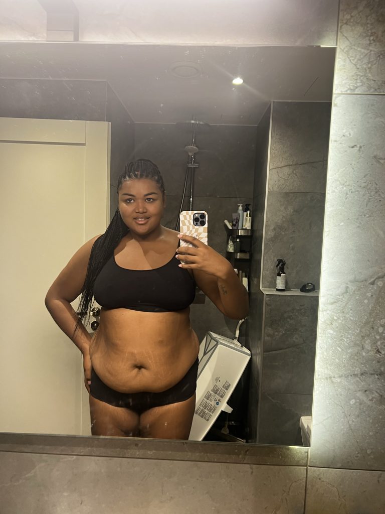 Kristina leikkauksesta: "Annan kokemukselleni rehellisesti arvosanaksi 10/10!" 1 Kristina Pärtelpoeg operatsioon kõhuplastika rasvaimu