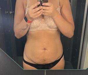 Минна-Май: Абдоминопластика даёт просто замечательный результат и гарантирует невероятное повышение самооценки! 2 kõhuplastika tummytuck