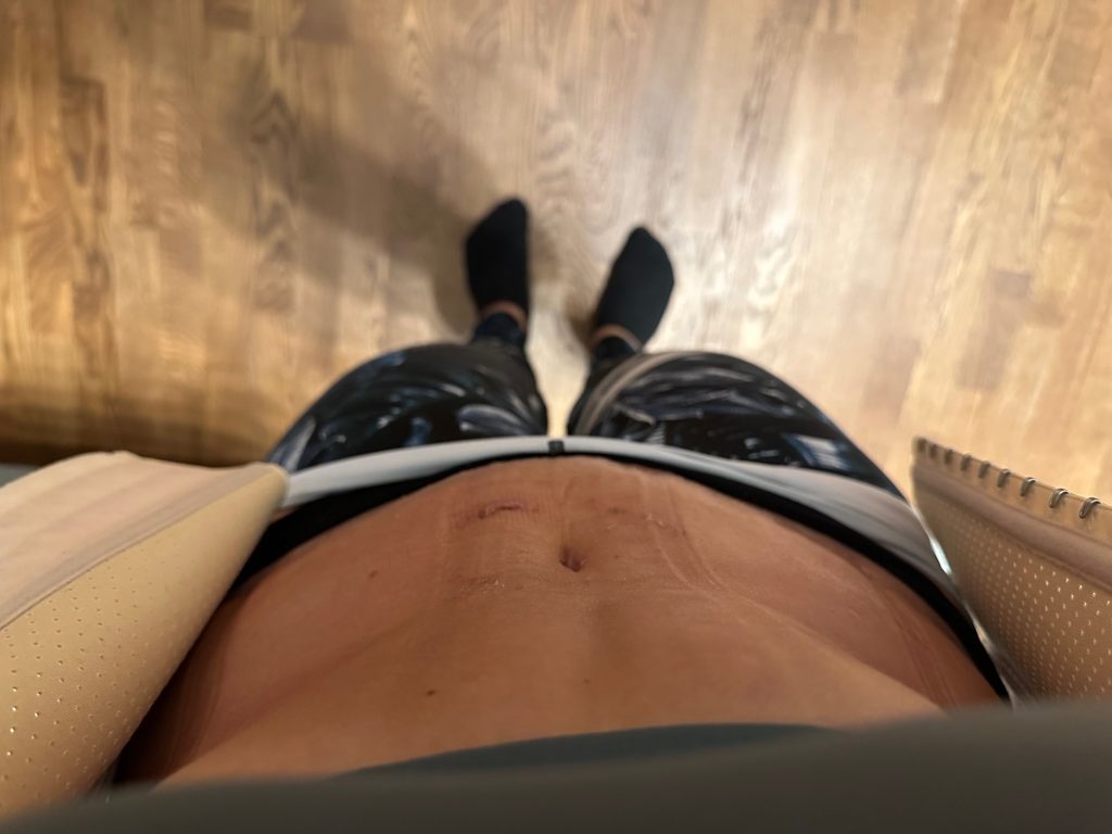 Минна-Май: Абдоминопластика даёт просто замечательный результат и гарантирует невероятное повышение самооценки! 6 kõhuplastika