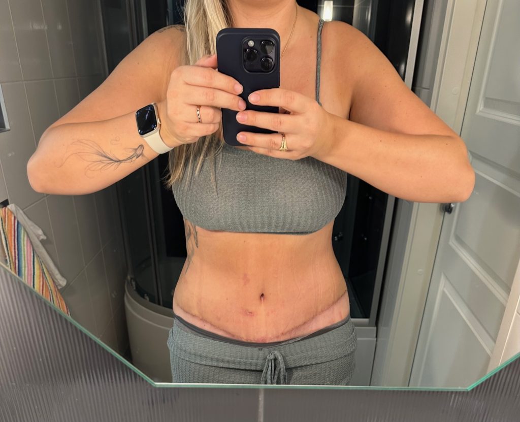 Минна-Май: Абдоминопластика даёт просто замечательный результат и гарантирует невероятное повышение самооценки! 5 kõhuplastika tummy tuck mommy makeover