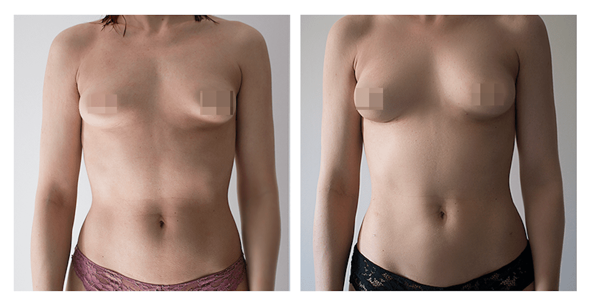 KOGEMUS: Rasva siirdamine rindadesse ehk lipofilling saleda figuuriga - hea kirurgi käe all võimalik! 3 lipofilling_before_after