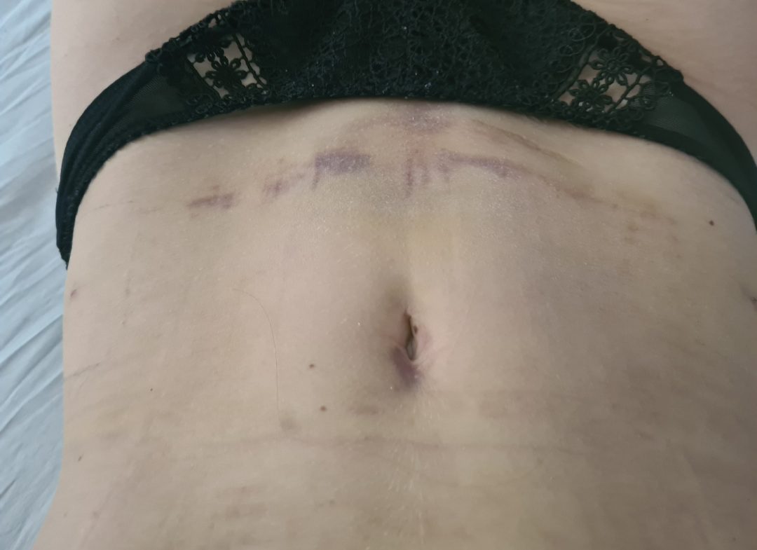 KOGEMUS: Rasva siirdamine rindadesse ehk lipofilling saleda figuuriga - hea kirurgi käe all võimalik! 4 lipofilling_rasvaimu