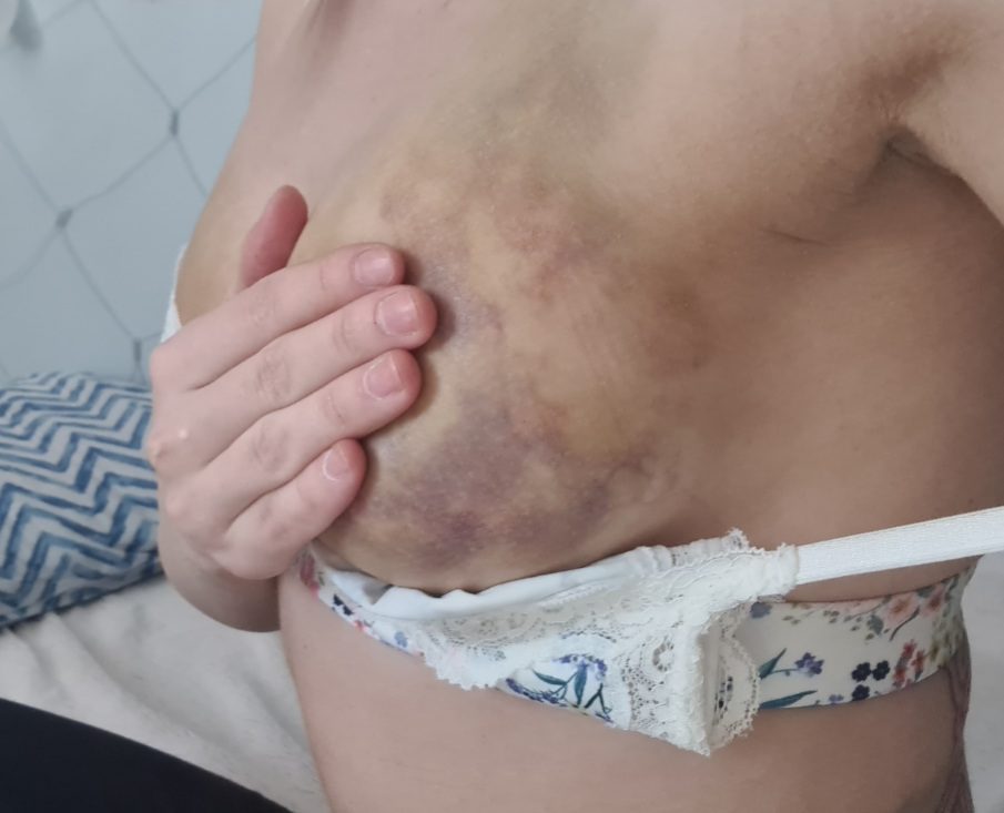 KOGEMUS: Rasva siirdamine rindadesse ehk lipofilling saleda figuuriga - hea kirurgi käe all võimalik! 5 lipofilling_rasvaimu