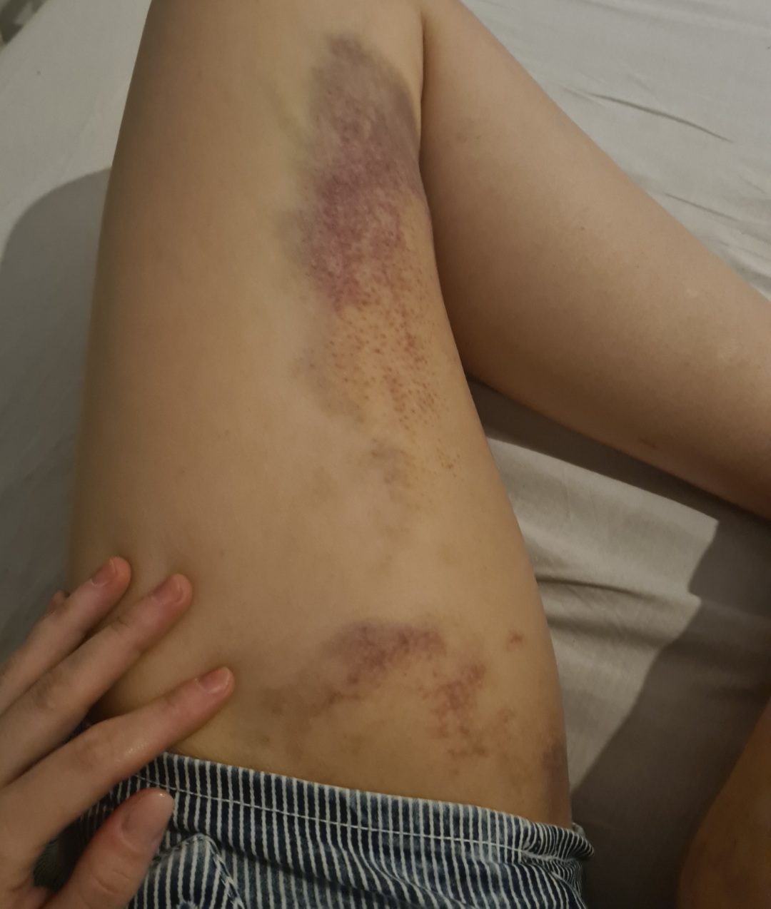 KOGEMUS: Rasva siirdamine rindadesse ehk lipofilling saleda figuuriga - hea kirurgi käe all võimalik! 6 lipofilling_rasvaimu