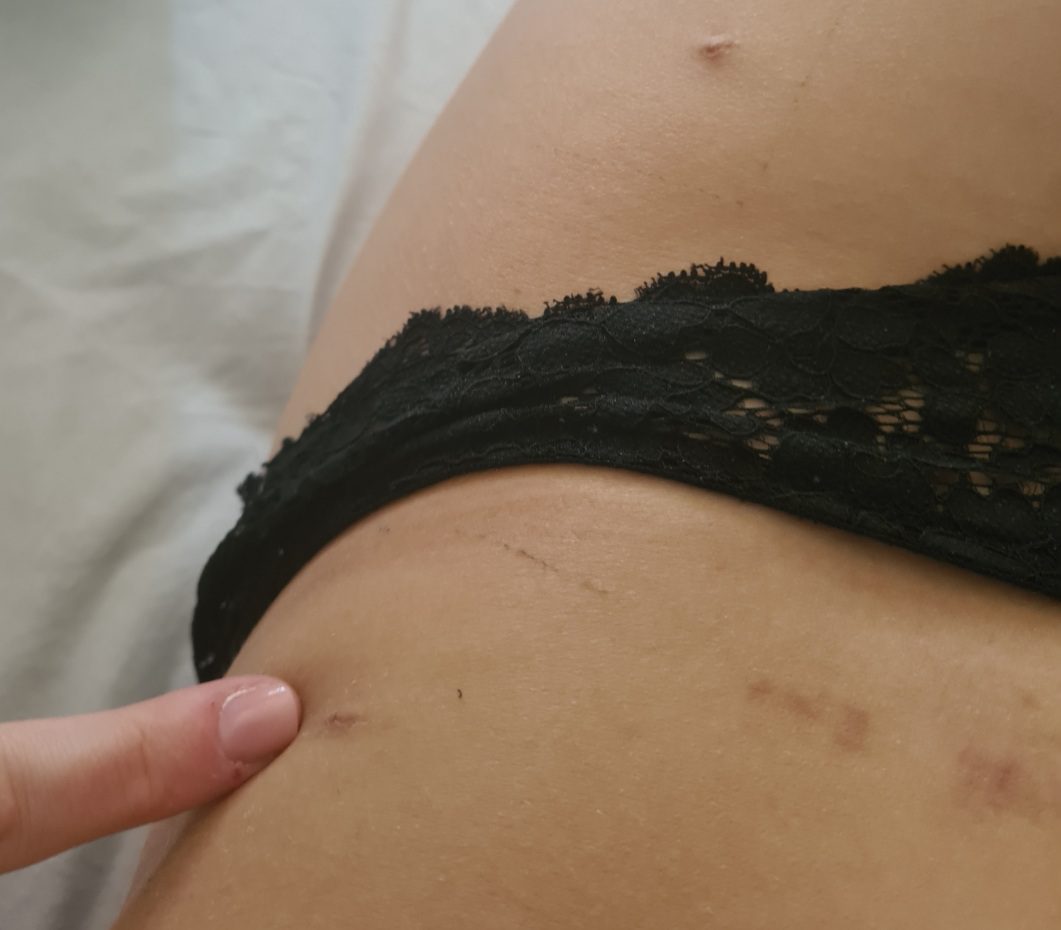 KOGEMUS: Rasva siirdamine rindadesse ehk lipofilling saleda figuuriga - hea kirurgi käe all võimalik! 7 lipofilling_rasvaimu