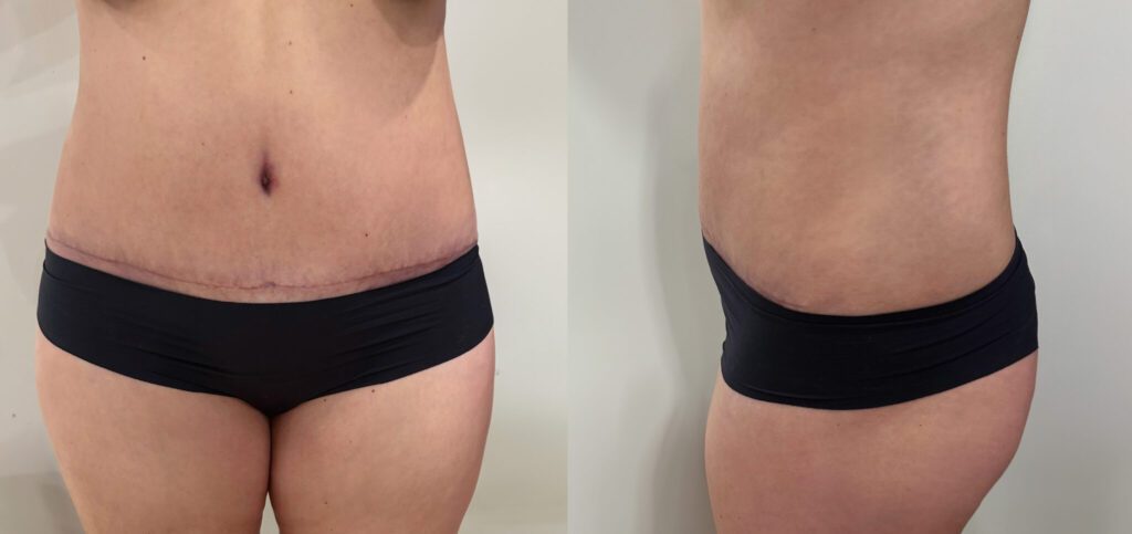 Виктория о своей операции по подтяжке живота: «Когда я увидела свой прекрасный живот, я испытала огромное чувство благодарности за то, что сделала себе такой подарок». 2 Виктория о своей операции по подтяжке живота: «Когда я увидела свой прекрасный живот, я испытала огромное чувство благодарности за то, что сделала себе такой подарок». 1