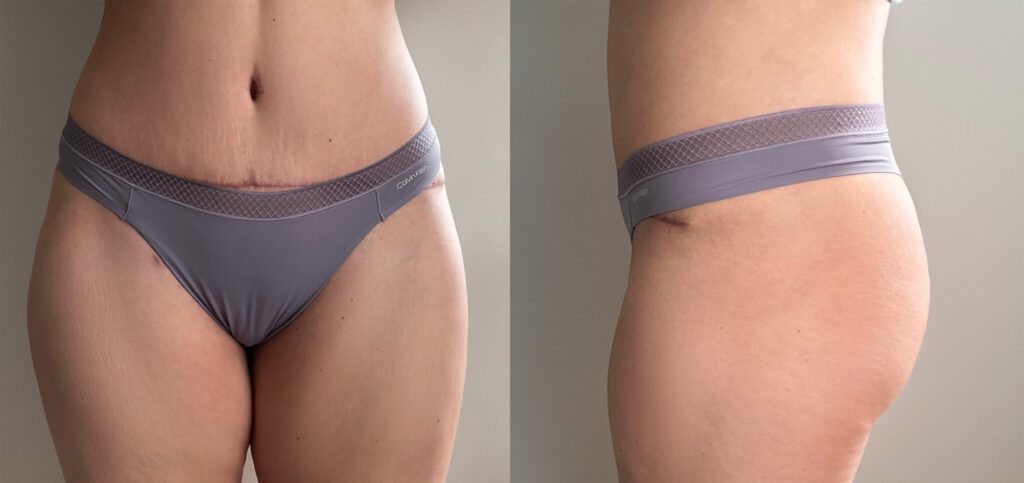 Виктория о своей операции по подтяжке живота: «Когда я увидела свой прекрасный живот, я испытала огромное чувство благодарности за то, что сделала себе такой подарок». 3 До Абдоминопластика