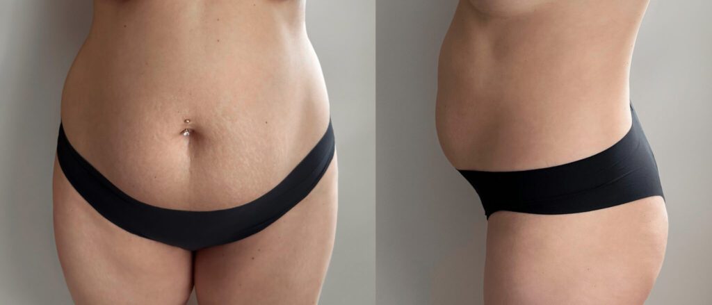 Виктория о своей операции по подтяжке живота: «Когда я увидела свой прекрасный живот, я испытала огромное чувство благодарности за то, что сделала себе такой подарок». 1 До Абдоминопластика