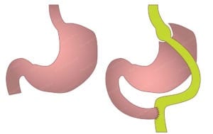 Gastric bypass