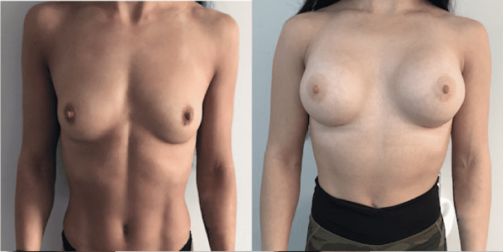 Увеличение груди До и после