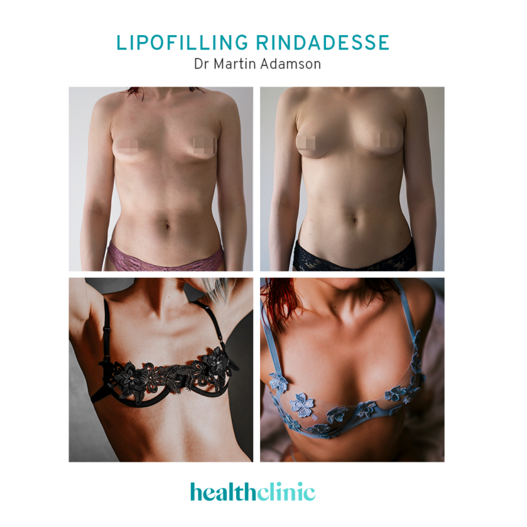 Lipofilling:before_after