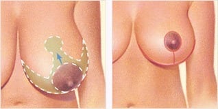 rindade vähendamine