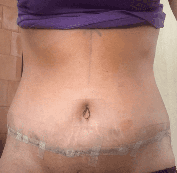 tummy tuck kõhuplastika