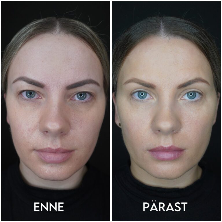 Мерили об операции на верхних веках и коррекции линии подбородка: «Повышение самооценки + уверенность в себе шли рука об руку!» 4 Мерили об операции на верхних веках и коррекции линии подбородка: «Повышение самооценки + уверенность в себе шли рука об руку!» 4