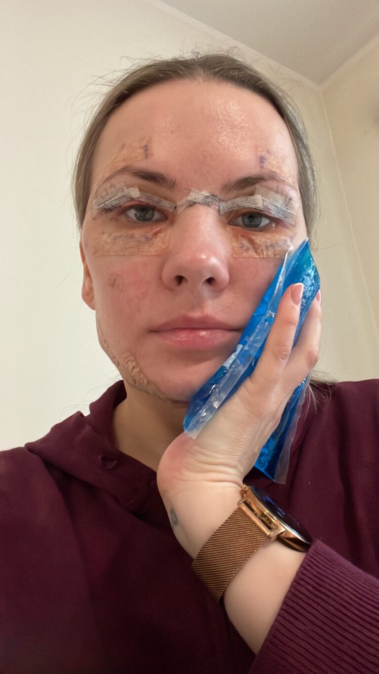 Мерили об операции на верхних веках и коррекции линии подбородка: «Повышение самооценки + уверенность в себе шли рука об руку!» 3 Мерили об операции на верхних веках и коррекции линии подбородка: «Повышение самооценки + уверенность в себе шли рука об руку!» 3