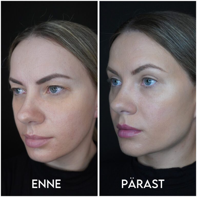 Мерили об операции на верхних веках и коррекции линии подбородка: «Повышение самооценки + уверенность в себе шли рука об руку!» 6 Мерили об операции на верхних веках и коррекции линии подбородка: «Повышение самооценки + уверенность в себе шли рука об руку!» 6