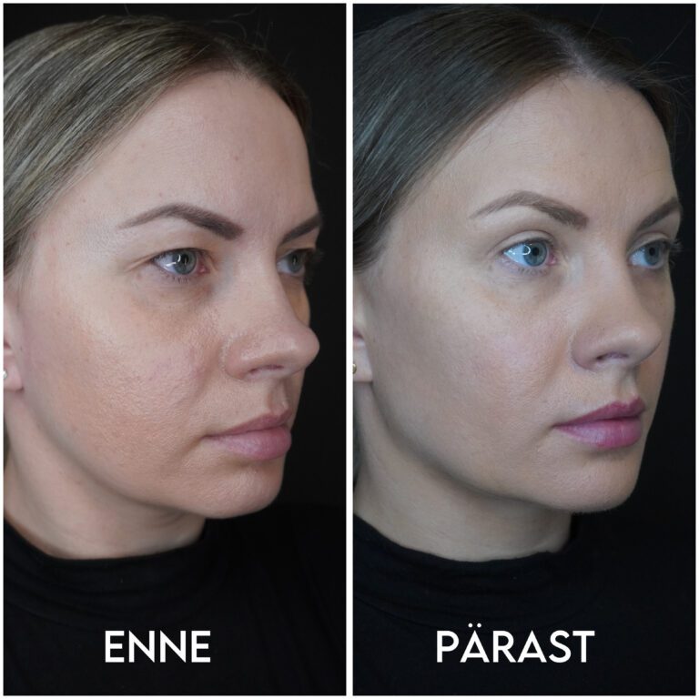 Мерили об операции на верхних веках и коррекции линии подбородка: «Повышение самооценки + уверенность в себе шли рука об руку!» 5 Мерили об операции на верхних веках и коррекции линии подбородка: «Повышение самооценки + уверенность в себе шли рука об руку!» 5