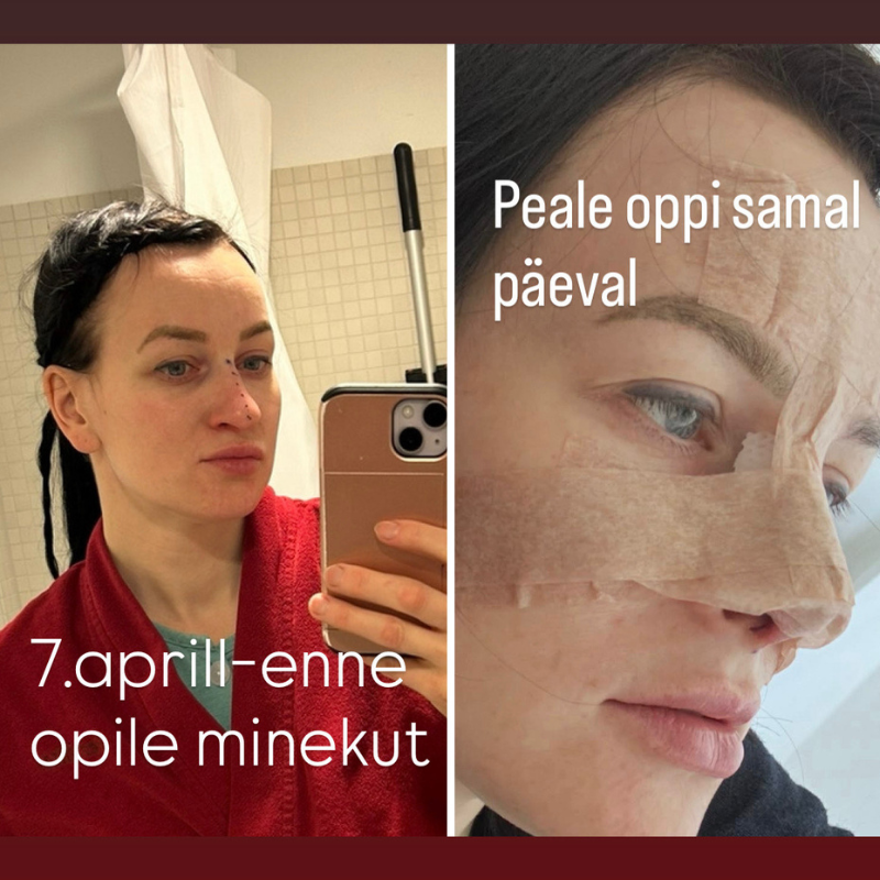 Ketlini ninaoperatsioon Health Clinicus: “Kui otsustan tulevikus endas midagi muuta, valin sama kliiniku ka edaspidi!” 2 Ketlini ninaoperatsioon Health Clinicus: “Kui otsustan tulevikus endas midagi muuta, valin sama kliiniku ka edaspidi!” 2