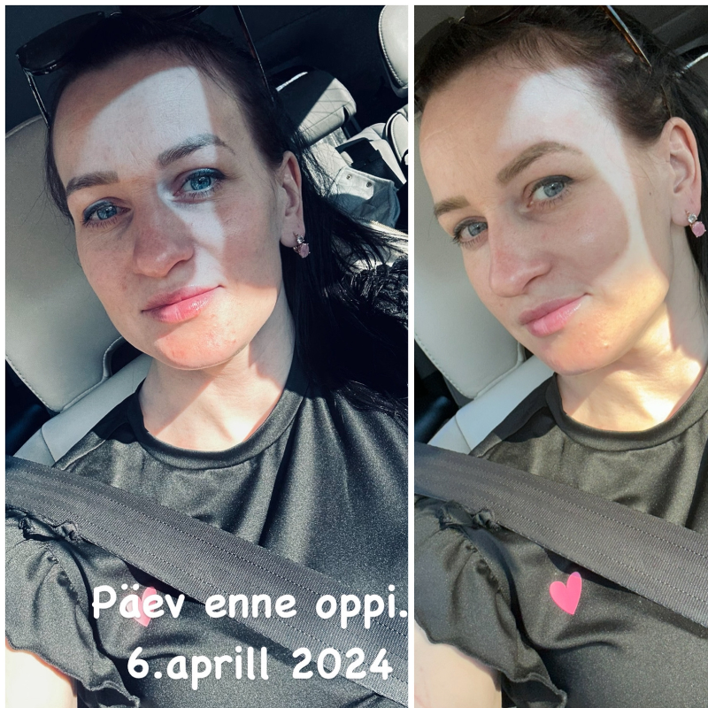 Ketlini ninaoperatsioon Health Clinicus: “Kui otsustan tulevikus endas midagi muuta, valin sama kliiniku ka edaspidi!” 1 Ketlini ninaoperatsioon Health Clinicus: “Kui otsustan tulevikus endas midagi muuta, valin sama kliiniku ka edaspidi!” 1