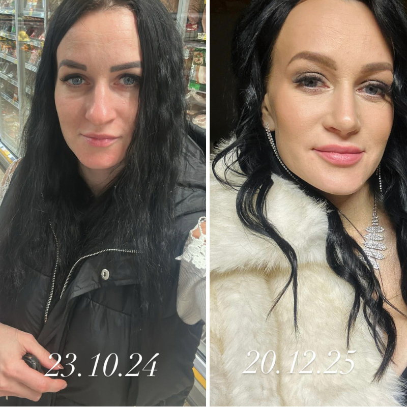 Ketlini ninaoperatsioon Health Clinicus: “Kui otsustan tulevikus endas midagi muuta, valin sama kliiniku ka edaspidi!” 4 Ketlini ninaoperatsioon Health Clinicus: “Kui otsustan tulevikus endas midagi muuta, valin sama kliiniku ka edaspidi!” 4