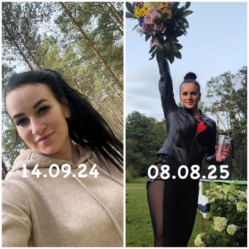 Ketlini ninaoperatsioon Health Clinicus: “Kui otsustan tulevikus endas midagi muuta, valin sama kliiniku ka edaspidi!” 5 Ketlini ninaoperatsioon Health Clinicus: “Kui otsustan tulevikus endas midagi muuta, valin sama kliiniku ka edaspidi!” 5