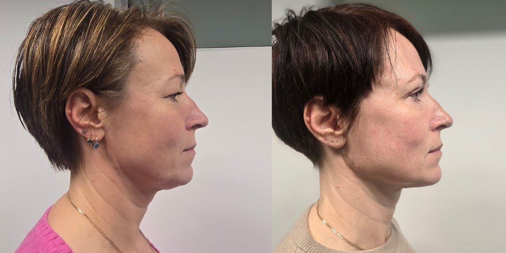 Siiri räägib Health Clinicus tehtud näo operatsioonidest: „Ma vaatan peeglisse ja naeratan endale taas“ 2