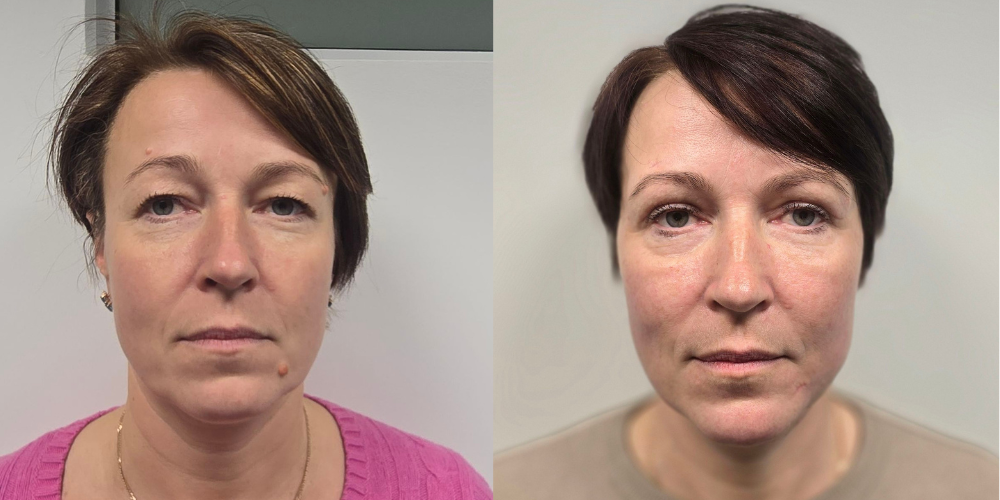 Siiri räägib Health Clinicus tehtud näo operatsioonidest: „Ma vaatan peeglisse ja naeratan endale taas“ 1