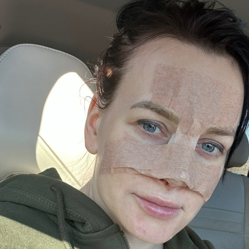 Ketlini ninaoperatsioon Health Clinicus: “Kui otsustan tulevikus endas midagi muuta, valin sama kliiniku ka edaspidi!” 3 Ketlini ninaoperatsioon Health Clinicus: “Kui otsustan tulevikus endas midagi muuta, valin sama kliiniku ka edaspidi!” 3