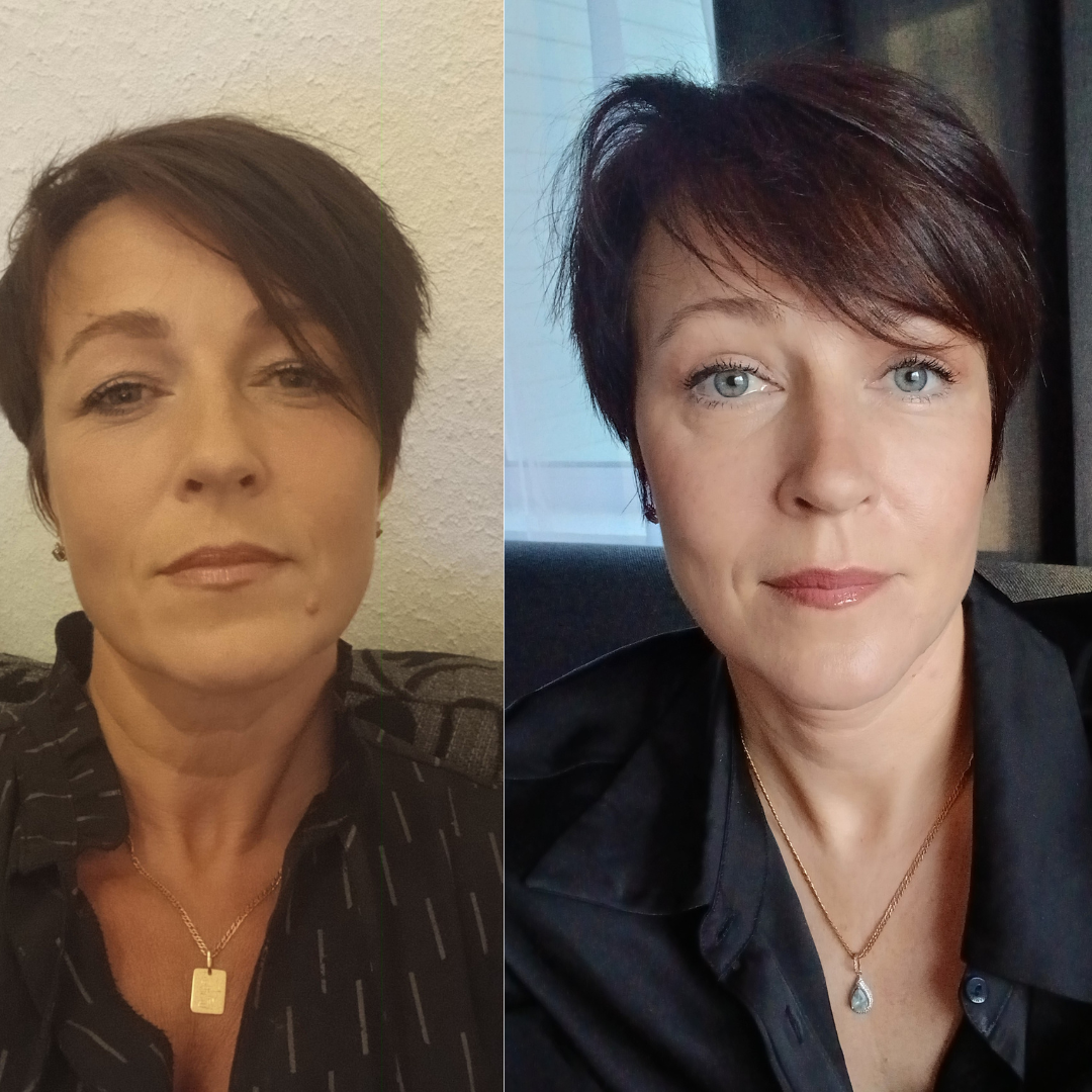 Siiri räägib Health Clinicus tehtud näo operatsioonidest: „Ma vaatan peeglisse ja naeratan endale taas“ 3